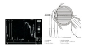 Biometria Calcula o Grau da Lente Intra Ocular