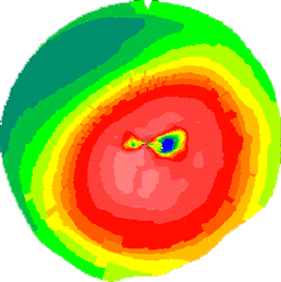 Ceratocone