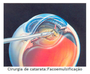 Cirurgia Catarata