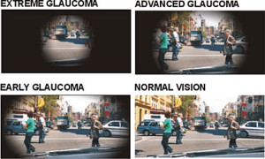 Glaucoma