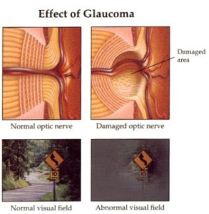 Glaucoma de pressão normal