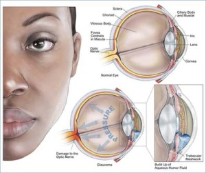 Glaucoma primário de ângulo aberto GPAA