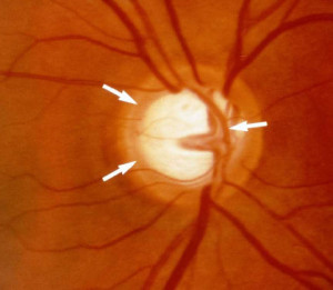 Glaucoma primário de ângulo aberto GPAA