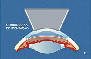 Gonioscopia - exame que avalia o ângulo da câmara anterior