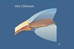 Gonioscopia - exame que avalia o ângulo da câmara anterior