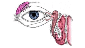 Obstrução do canal lacrimal