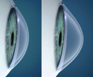 Paquimetria Ultrassônica - Mede a espessura da córnea