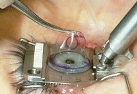 Pós-operatório da Cirurgia Refrativa