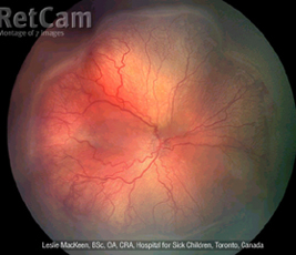 Retinopatia da prematuridade