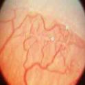 Retinopatia da prematuridade