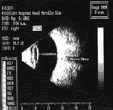 Ultrassonografia ou Ecografia ocular